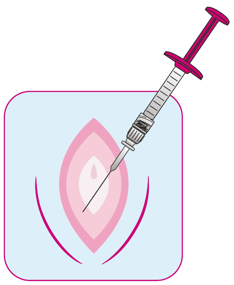 Regenyal Armonia Hyaluronsäure: Innovative Lösung für Intimverjüngung und Genitalkorrektur 2x1ml Regenyal Armonia Hyaluronsäure: Innovative Lösung für Intimverjüngung und Genitalkorrektur 2x1ml